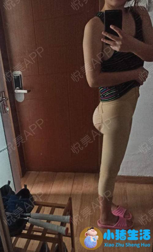 大腿吸脂术后注意事项