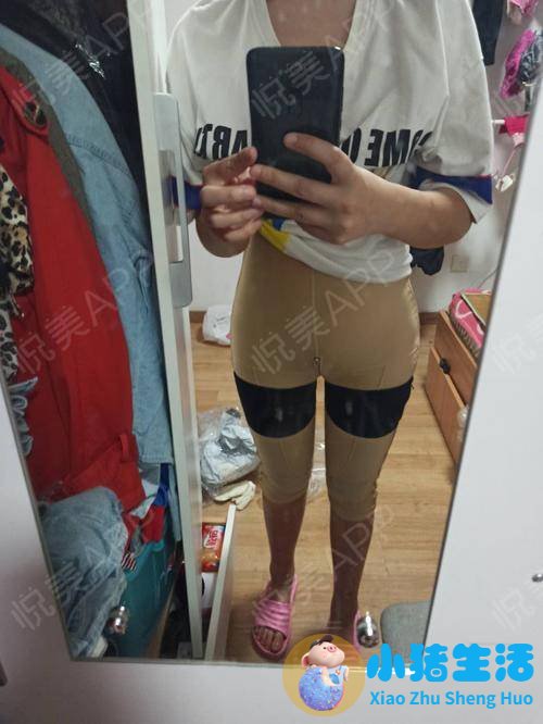 大腿吸脂术后注意事项