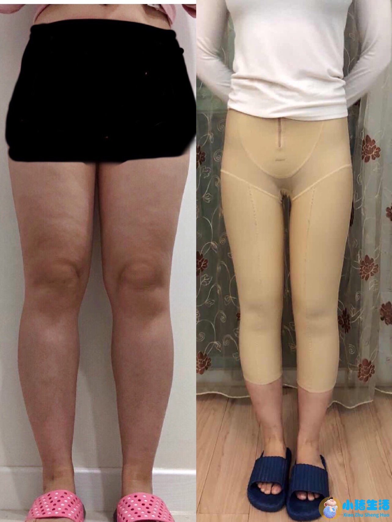 大腿吸脂术后注意事项