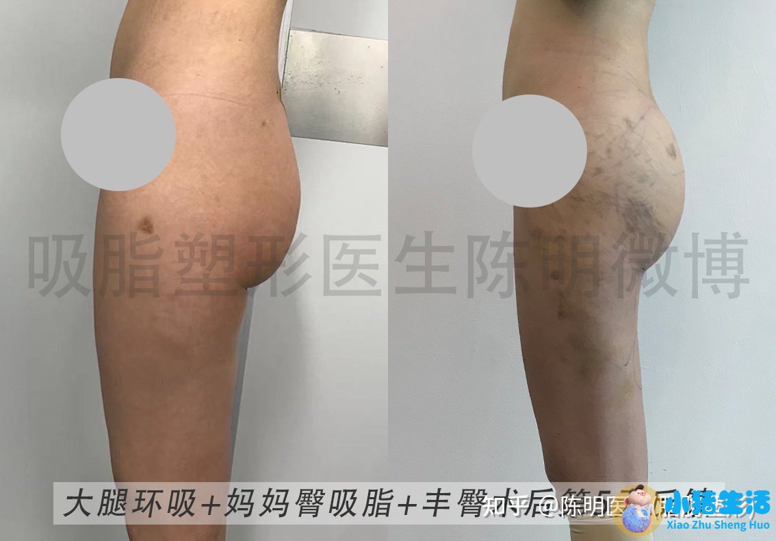 大腿吸脂术后注意事项