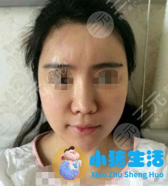 长春中妍赵胜有整形失败案例