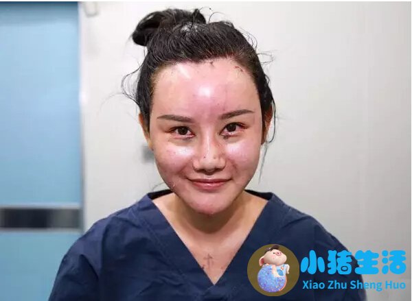 长春中妍赵胜有整形失败案例