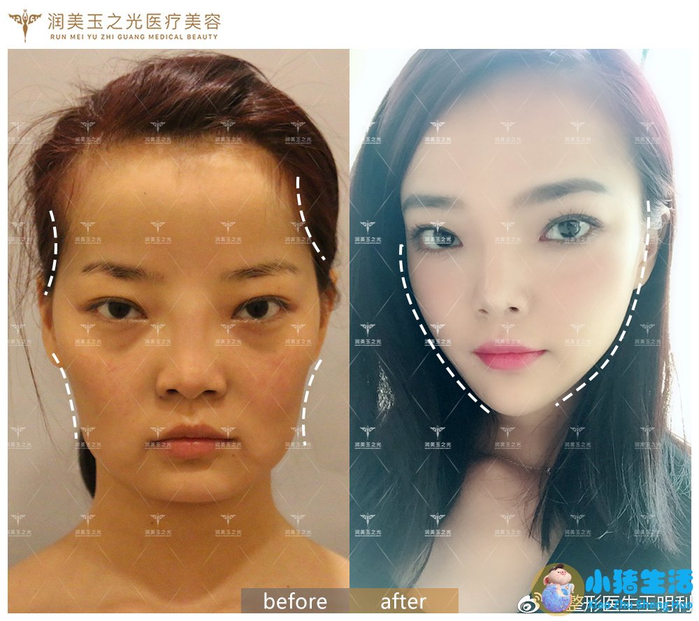 长春中妍赵胜有整形失败案例