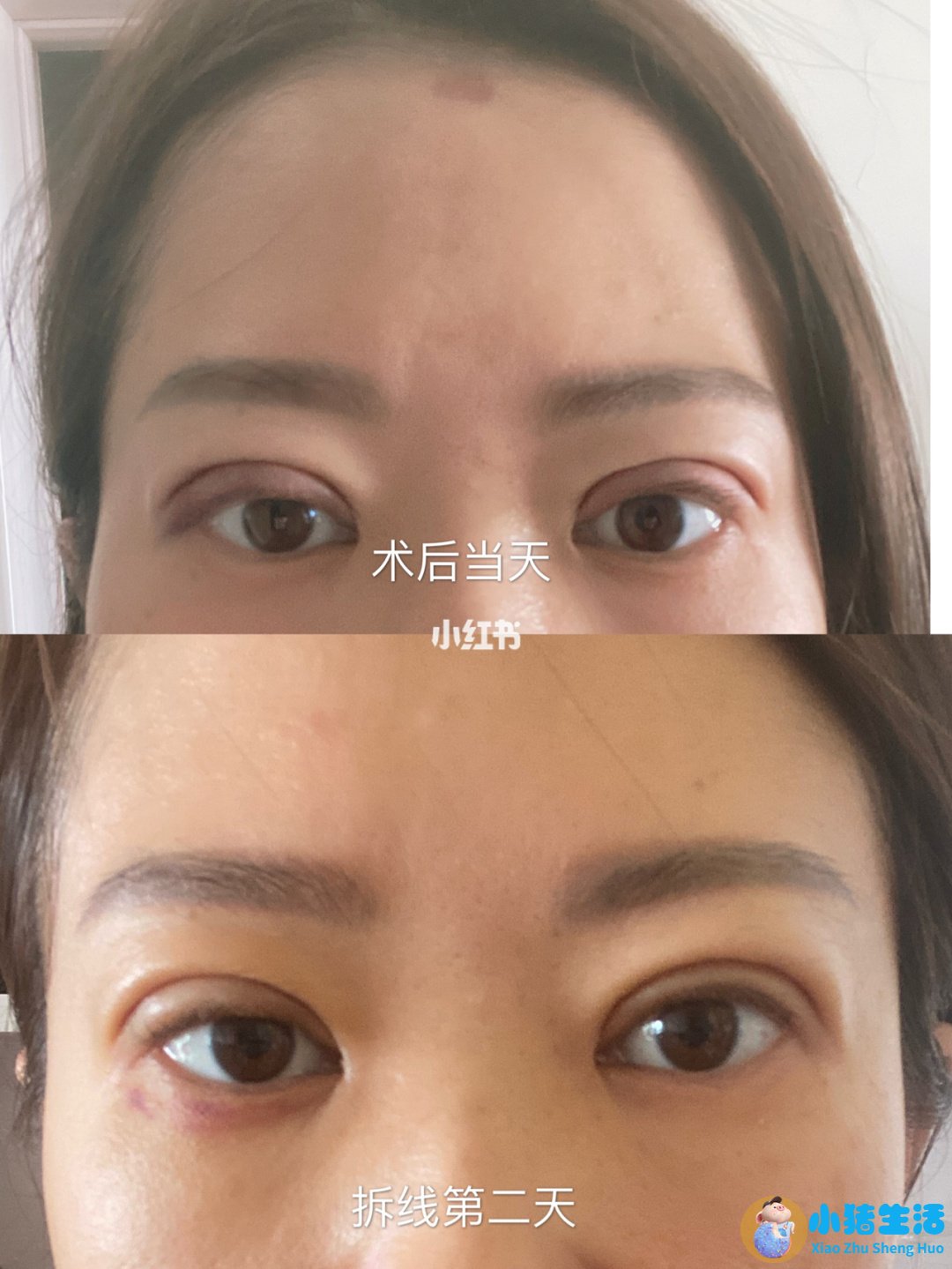 双眼皮整形案例图片