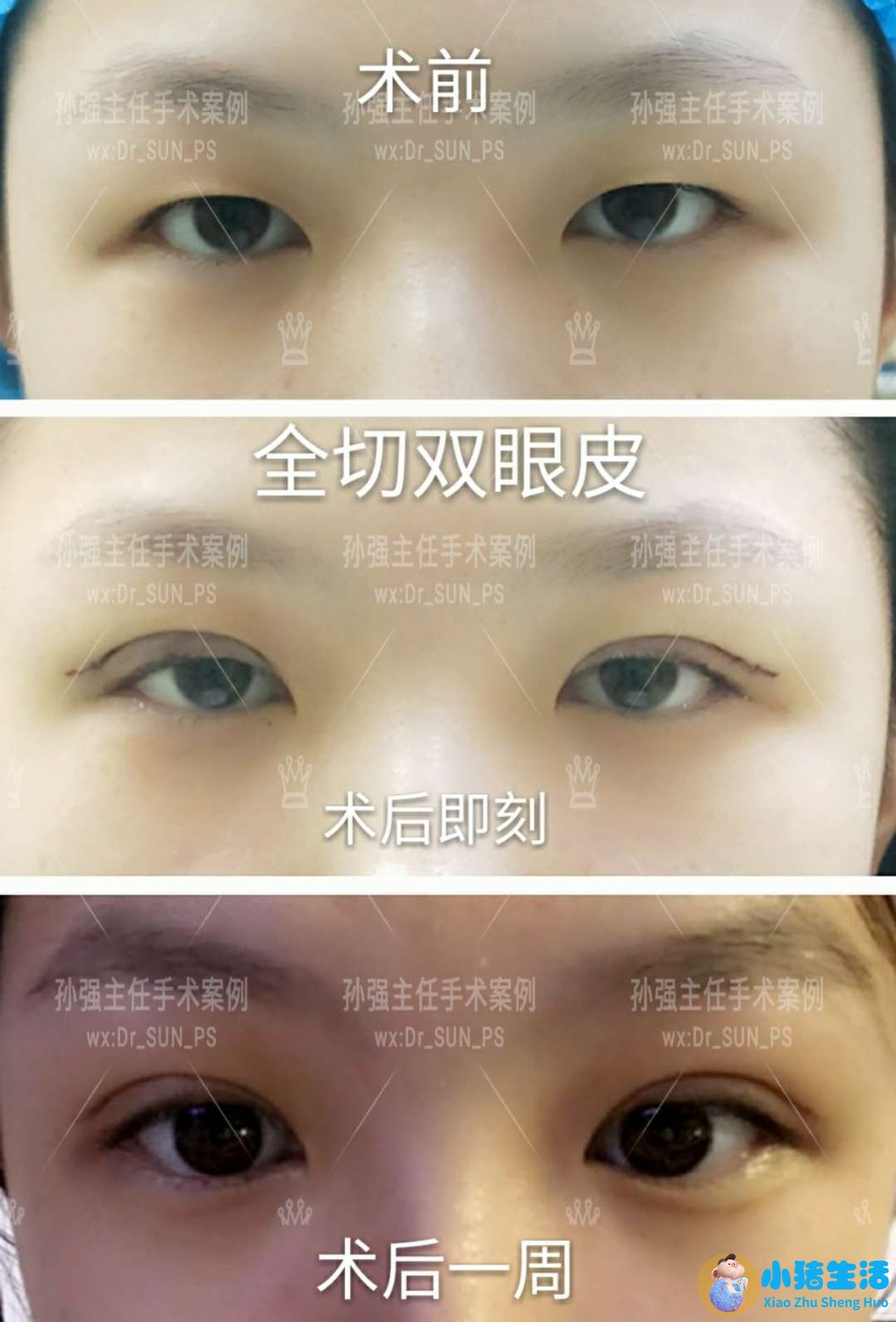 双眼皮整形案例图片