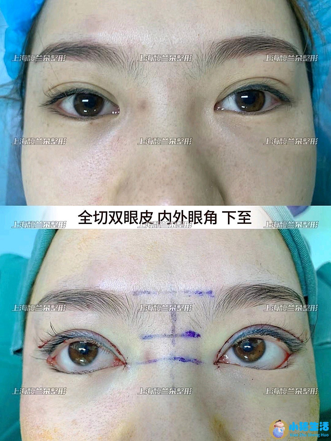 双眼皮整形案例图片