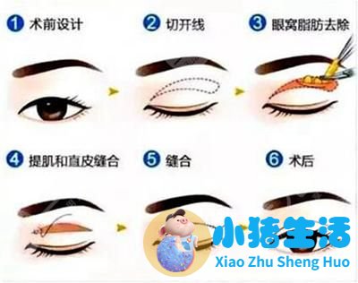 双眼皮整形案例图片