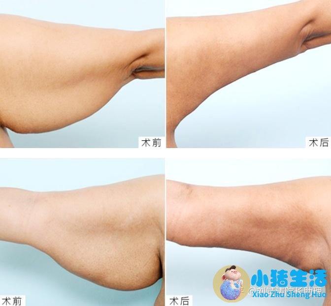 手臂局部减肥
