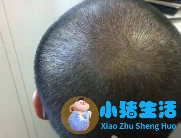 头发移植去哪里好