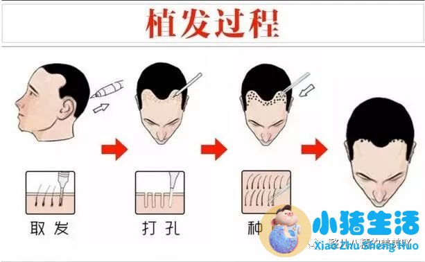 头发移植去哪里好