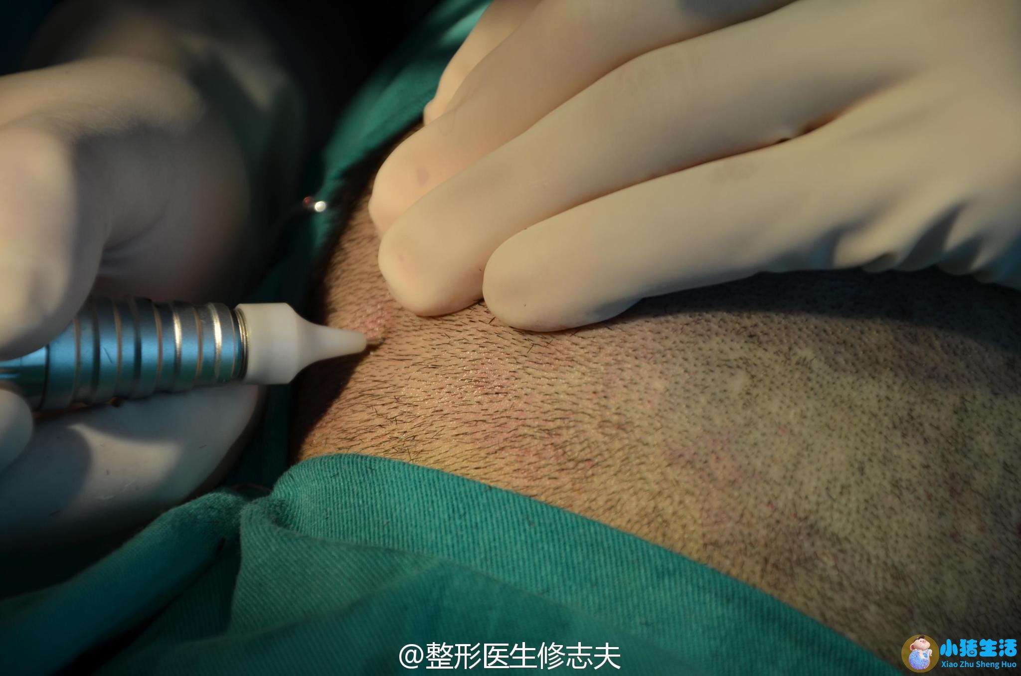 头发移植去哪里好