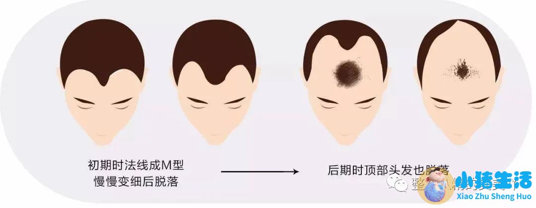 头发移植去哪里好