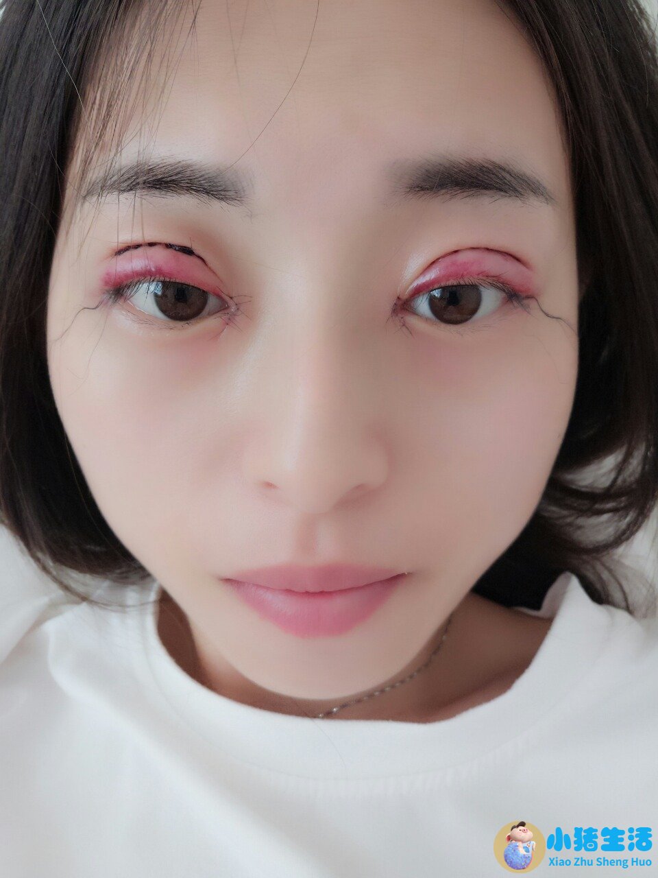 整形失败案例