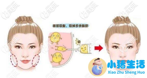 面部吸脂前后对比图