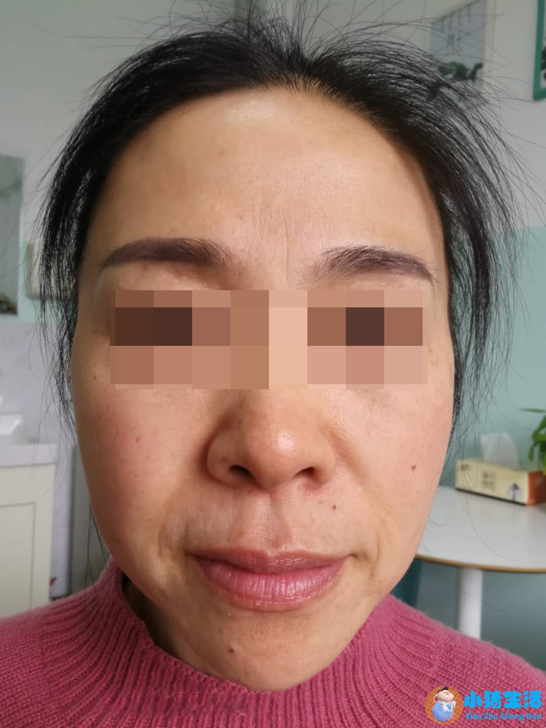 整形失败案例