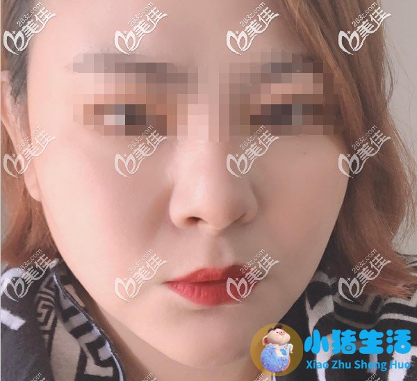面部埋线提升三个月效果图