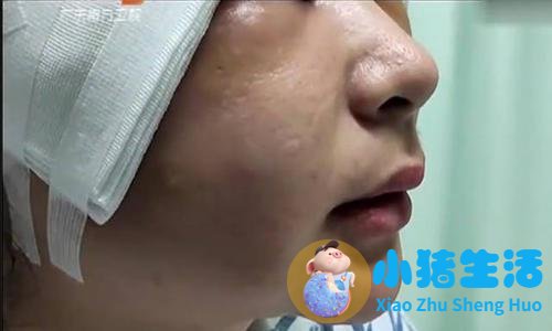 整形失败案例