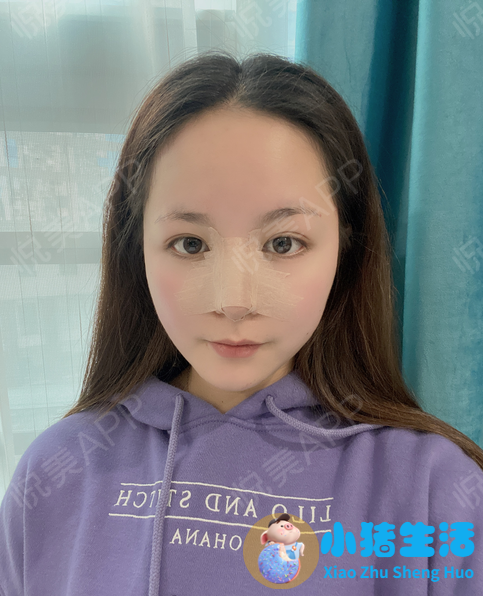 整形失败案例