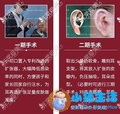 招风耳整形案例