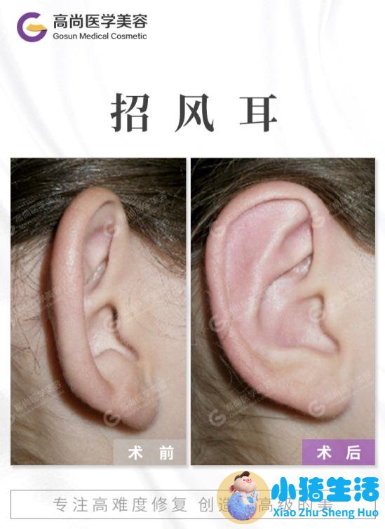 招风耳整形案例