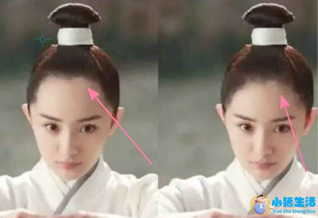 种植头发需要多钱