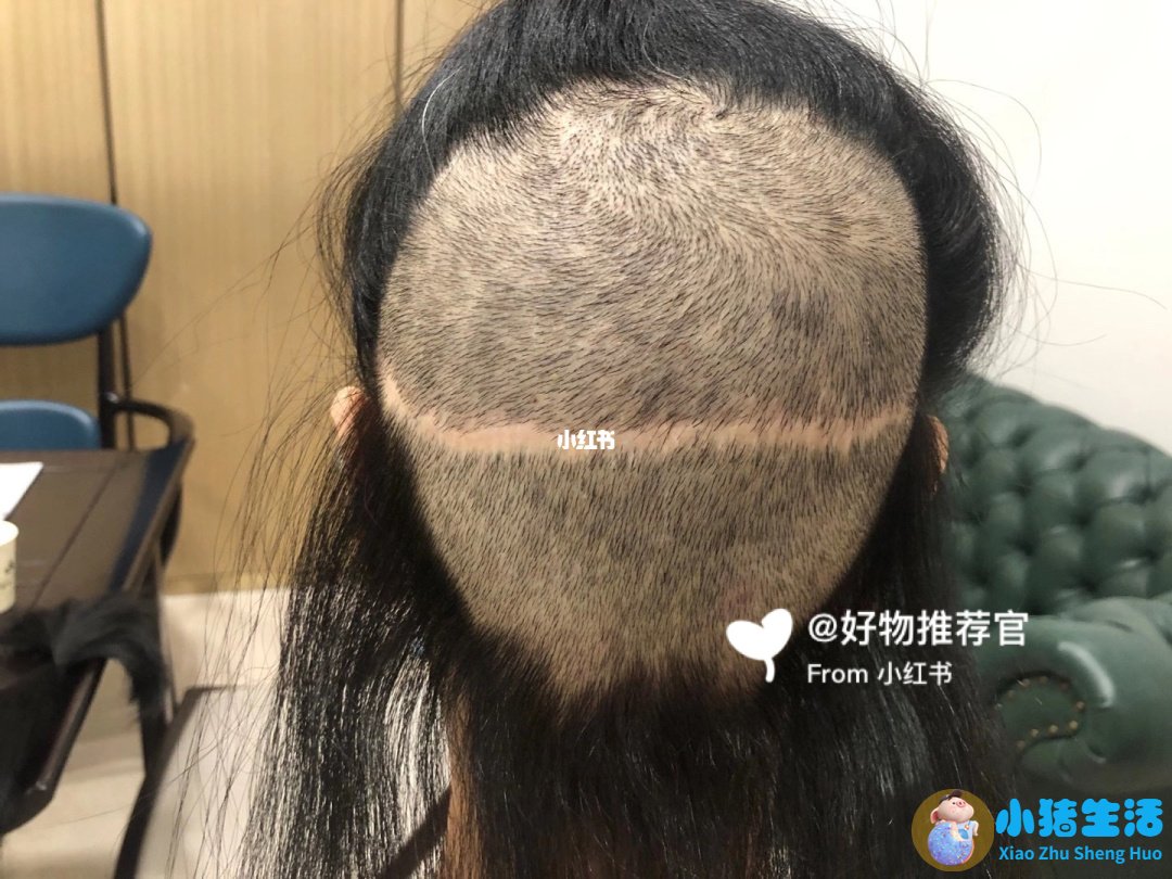 种植头发需要多钱