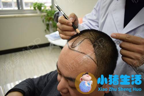 种植头发多少钱？种植头发大概需要多少费用
