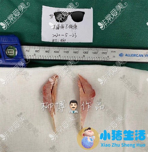 邱立东整形失败案例