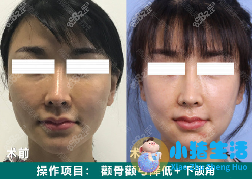 邱立东整形失败案例