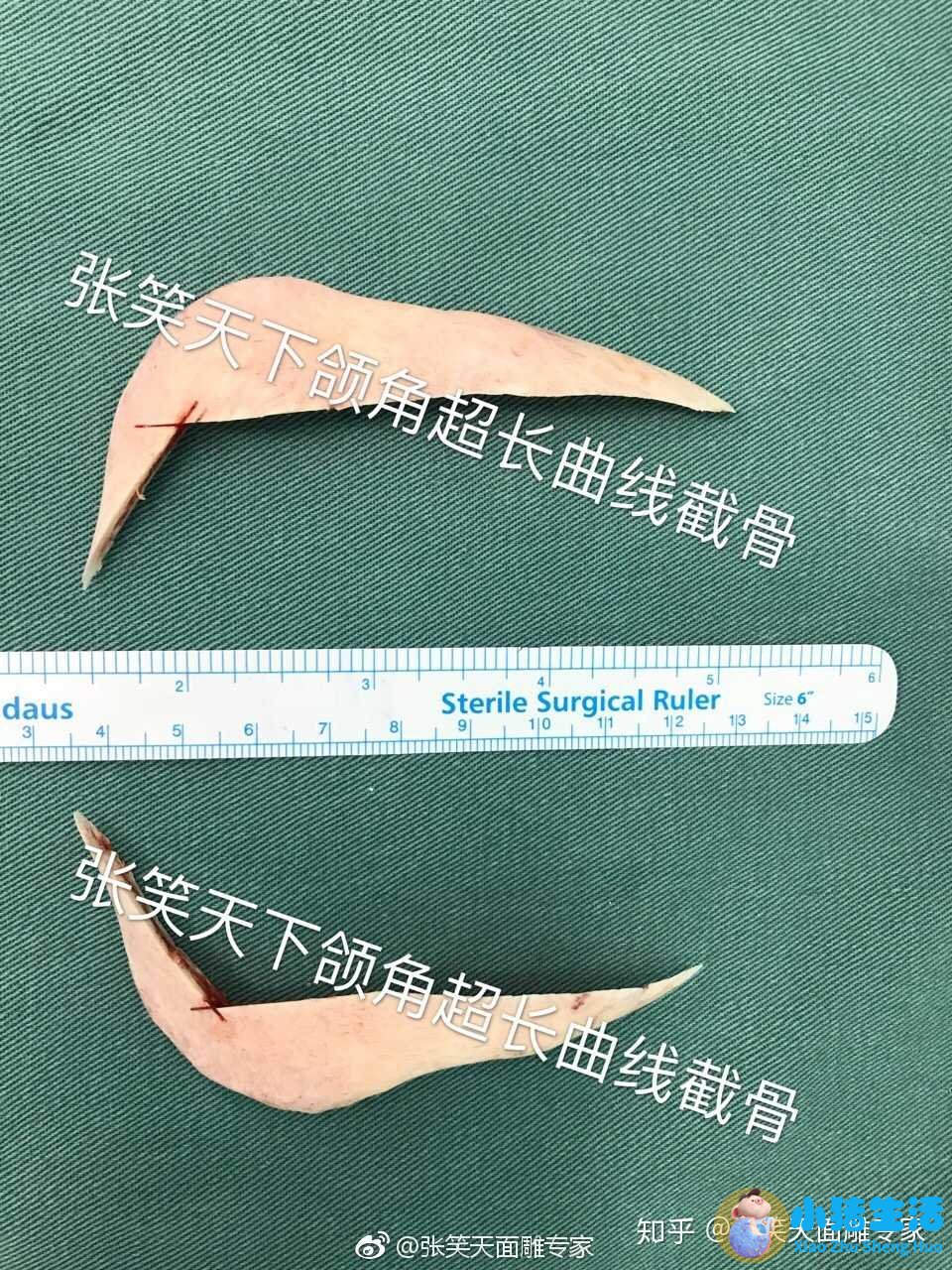 邱立东整形失败案例