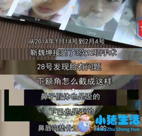 邱立东整形失败案例