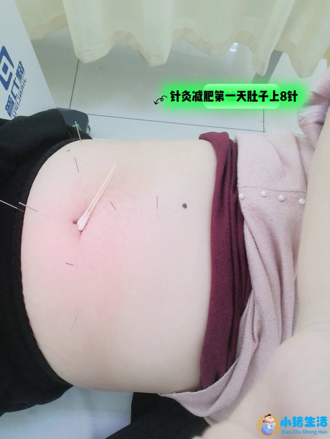 针灸局部减肥