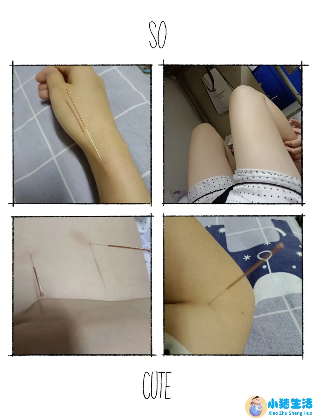 针灸局部减肥