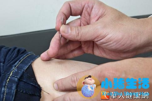 针灸局部减肥