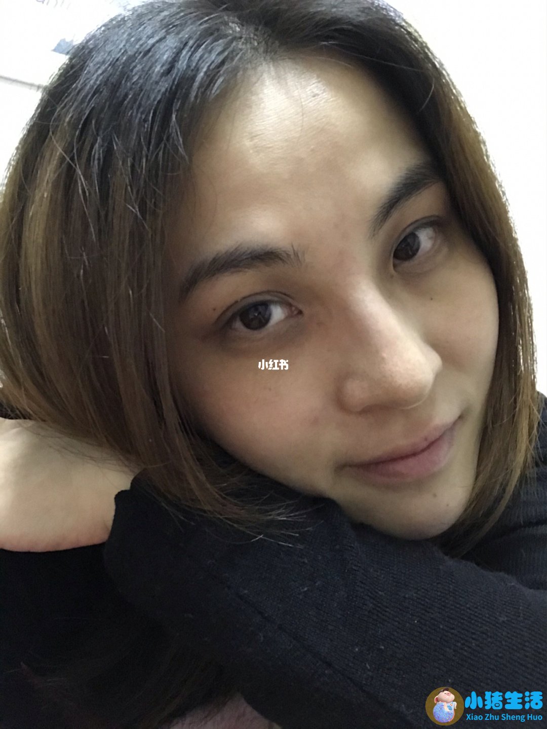 做电波拉皮除皱价