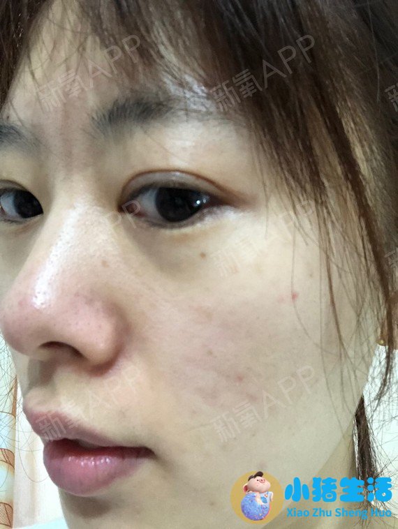 做电波拉皮除皱价