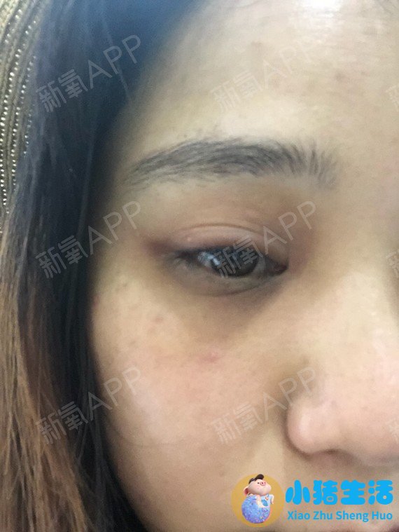 做电波拉皮除皱价