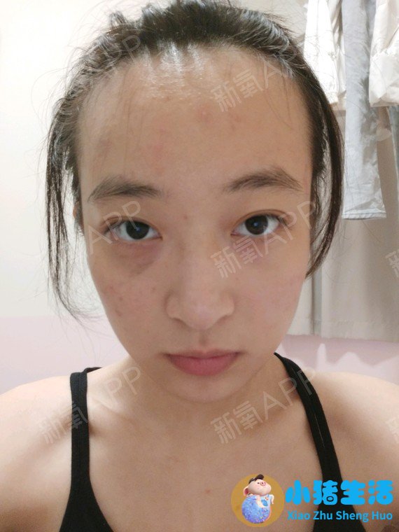 做电波拉皮除皱价