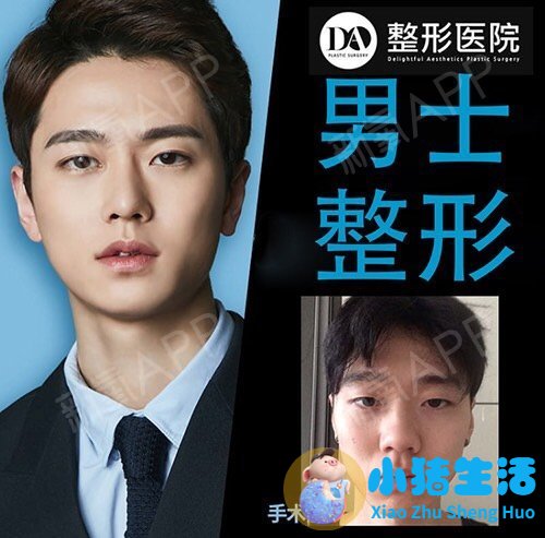 做电波拉皮除皱价