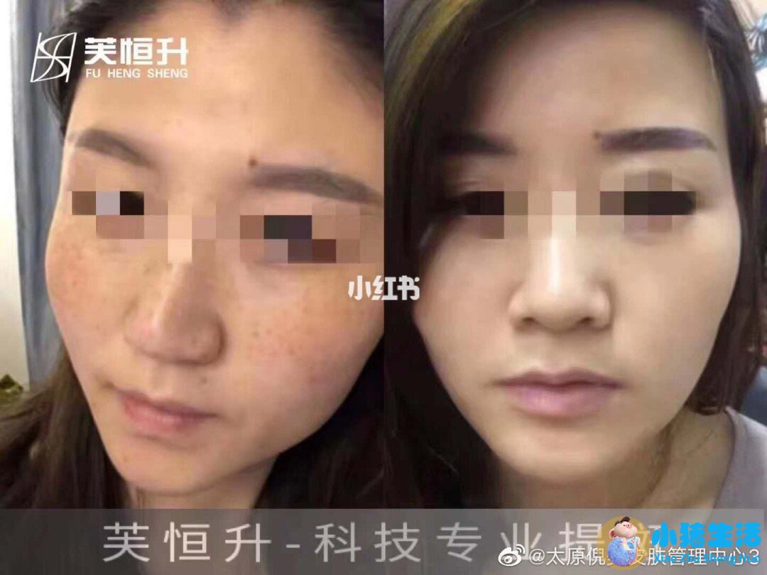 祛斑的产品哪个牌子好