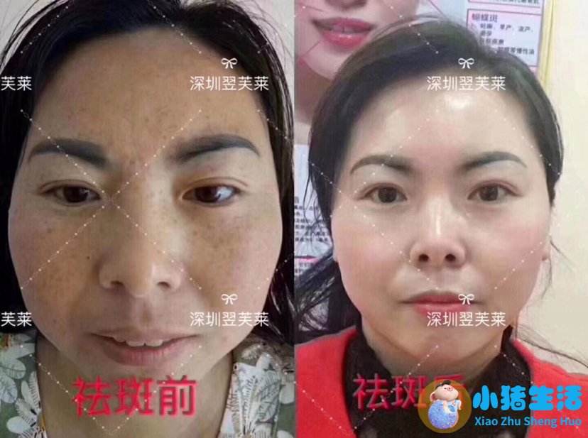 祛斑的产品哪个牌子好