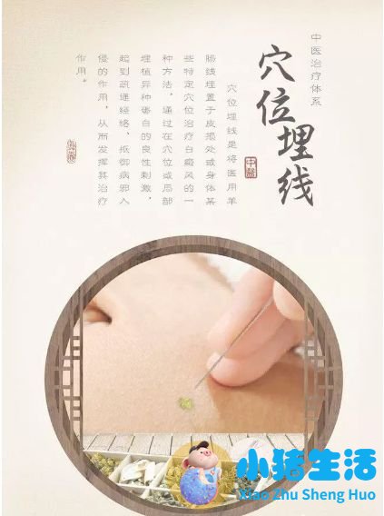 埋线局部减肥