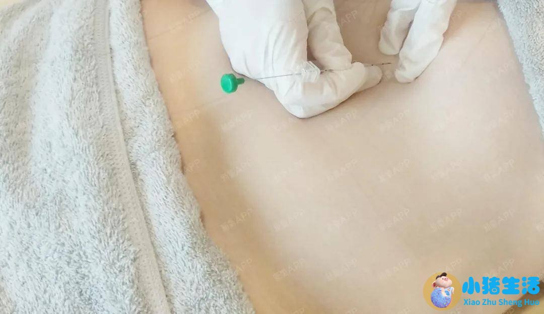 埋线局部减肥
