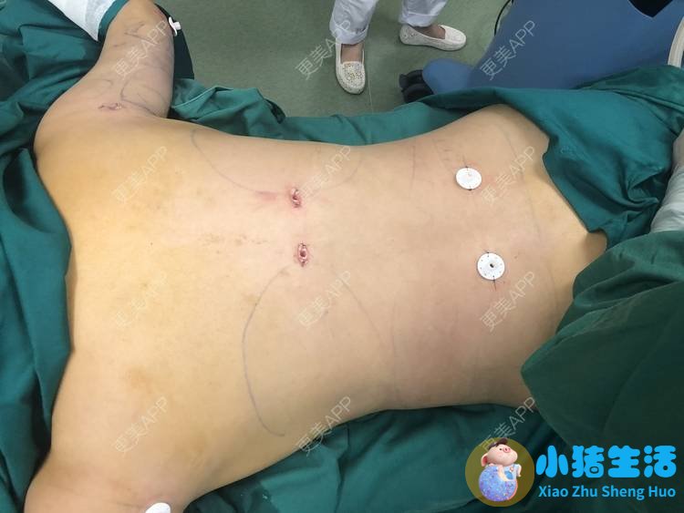 全身抽脂需要多少钱