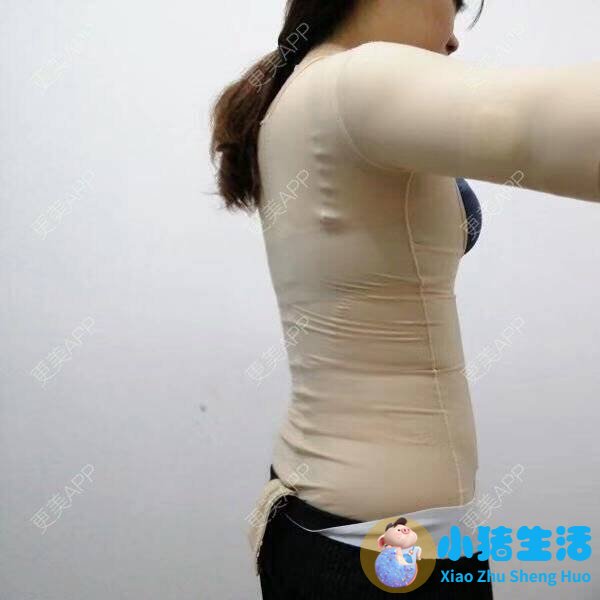 全身抽脂需要多少钱