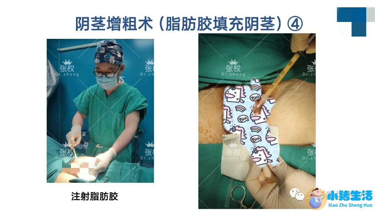 全身抽脂需要多少钱