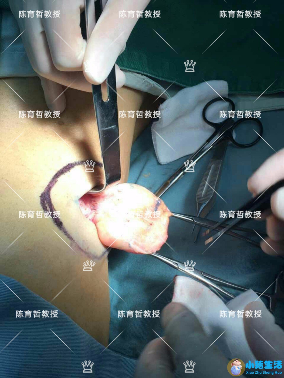 全身抽脂需要多少钱