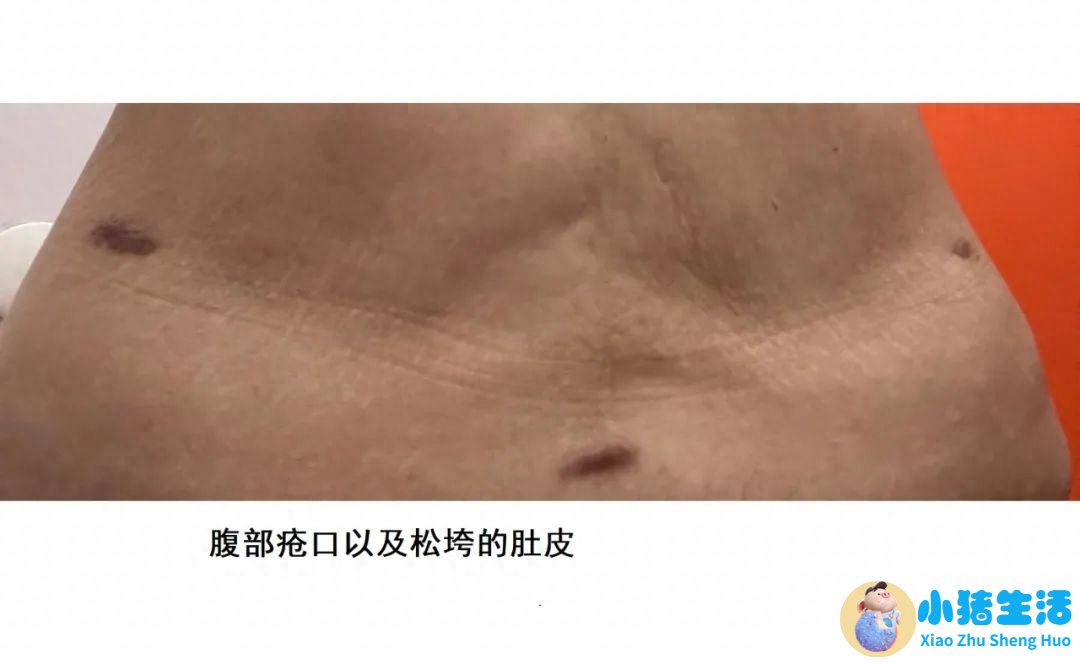 全身抽脂需要多少钱