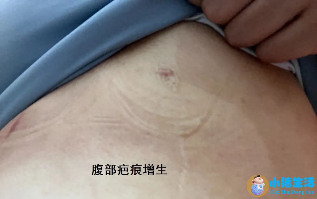 全身抽脂需要多少钱