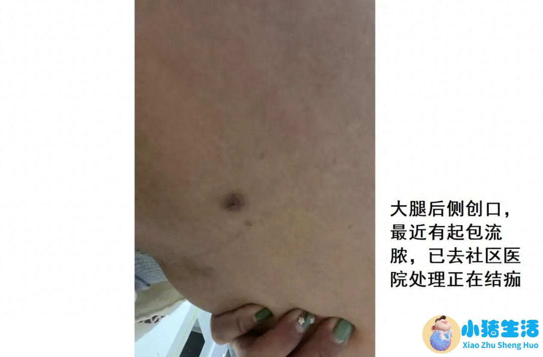 全身抽脂需要多少钱